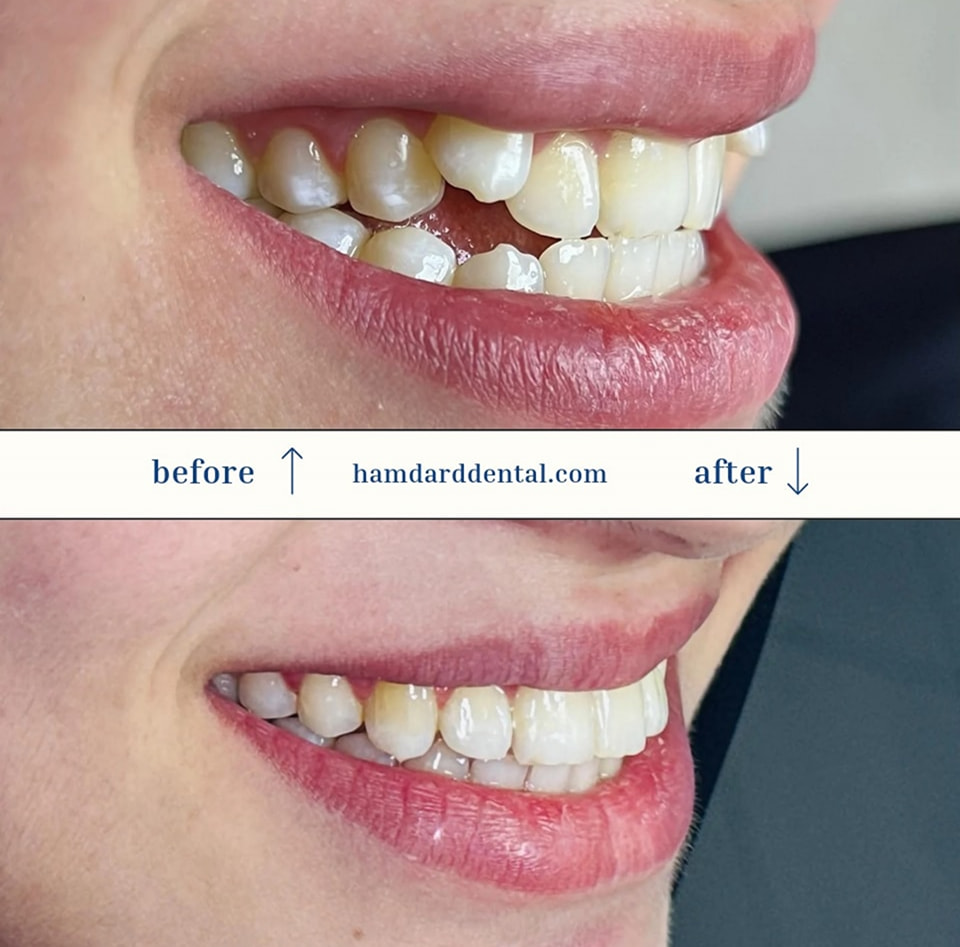 Before and after smile transformation with cosmetic dentistry and orthodontics at Hamdard Dental Clinic in Kabul