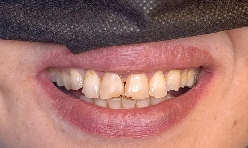 Anterior teeth damage before treatment at Hamdard Dental Clinic in Kabul
