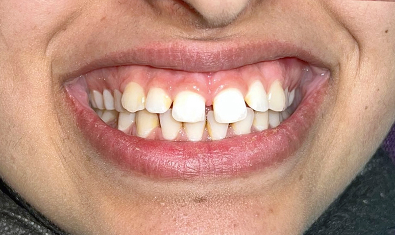 Before orthodontic treatment at Hamdard Dental Clinic in Kabul