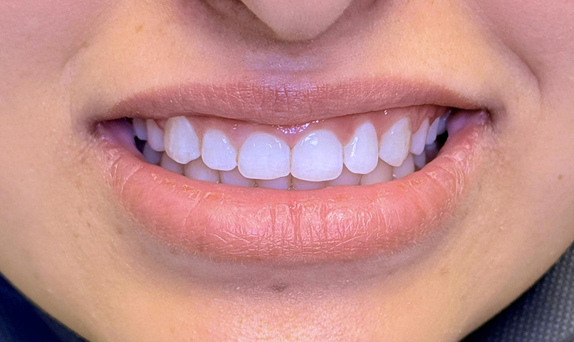 Teeth after orthodontic treatment in Kabul dental clinic