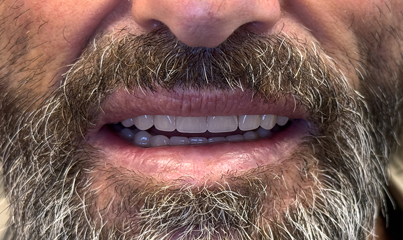 After complete denture treatment in Kabul dental clinic