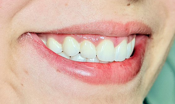 After treatment of enamel hypoplasia at Hamdard Dental Clinic in Kabul